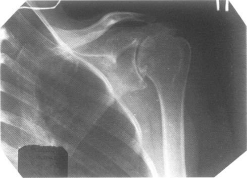 Рентген плечевого сустава что показывает 195