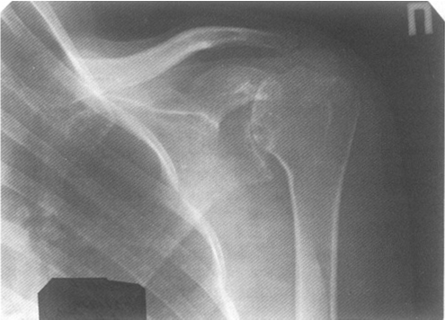 Рентген плечевого сустава что показывает 150