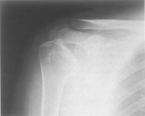 Рентген плечевого сустава что показывает 168