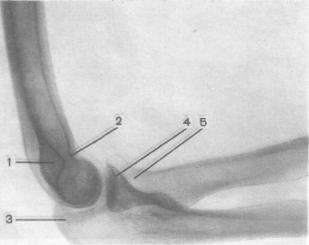 Рентгеновские снимки плечевого сустава 70