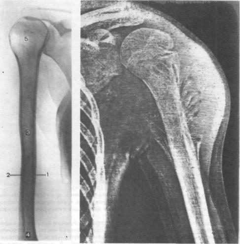 Рентгеновские снимки плечевого сустава 14
