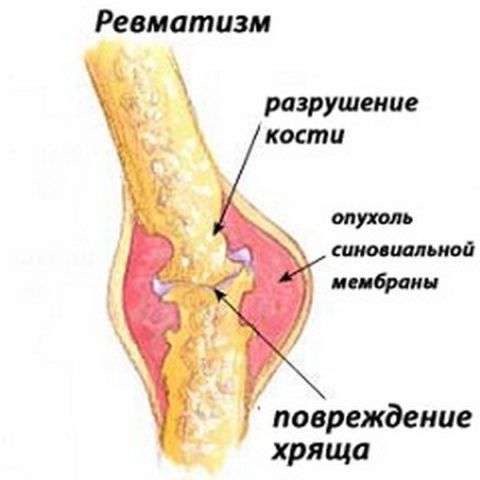 Ревматизм коленного сустава симптомы 142