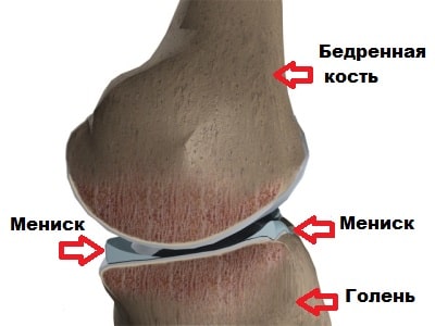 Резекция внутреннего мениска коленного сустава 185