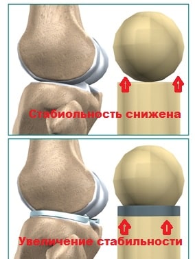 Резекция внутреннего мениска коленного сустава 14