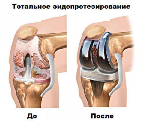 Российский эндопротез коленного сустава 134