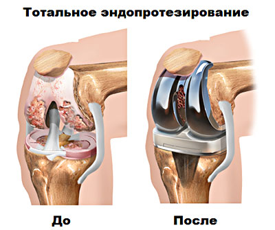Российский эндопротез коленного сустава 89