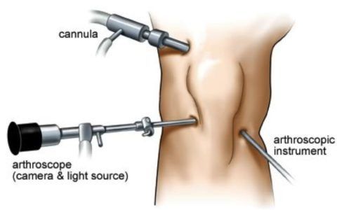 Санационная диагностическая артроскопия плечевого сустава 13