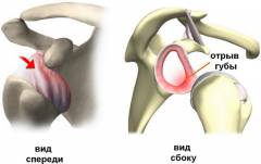 Санационная диагностическая артроскопия плечевого сустава 9
