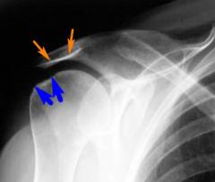 Санационная диагностическая артроскопия плечевого сустава 23