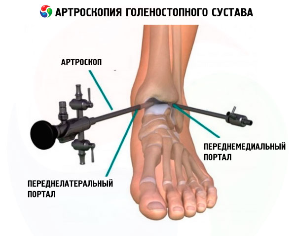 Щель голеностопного сустава 47