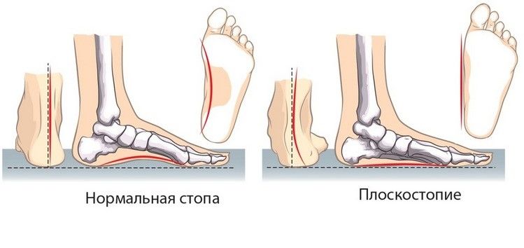 Щель голеностопного сустава 53