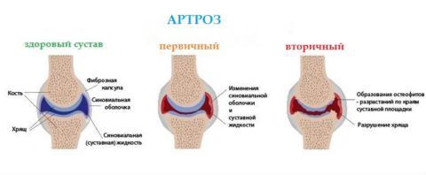 Щель голеностопного сустава 136