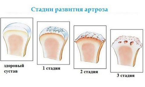 Щель голеностопного сустава 129