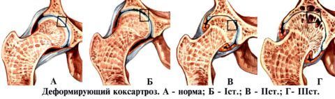 Симптомы коксартроза 4 степени тазобедренного сустава 4