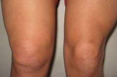 Синусит коленного сустава лечение 71