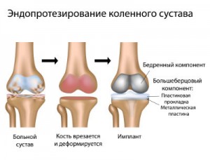 Сколько стоит операция эндопротезирования коленного сустава 145