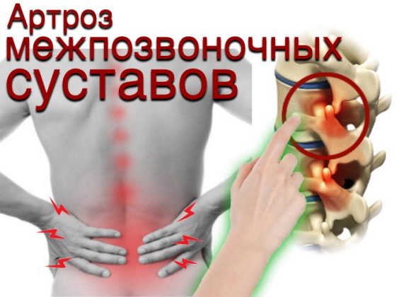 Спондилоартроз фасеточных суставов