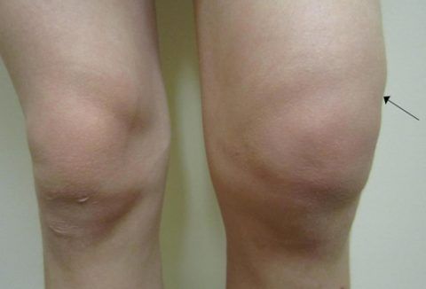 Срок иммобилизации при гемартрозе коленного сустава 89
