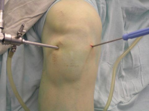 Срок иммобилизации при гемартрозе коленного сустава 112