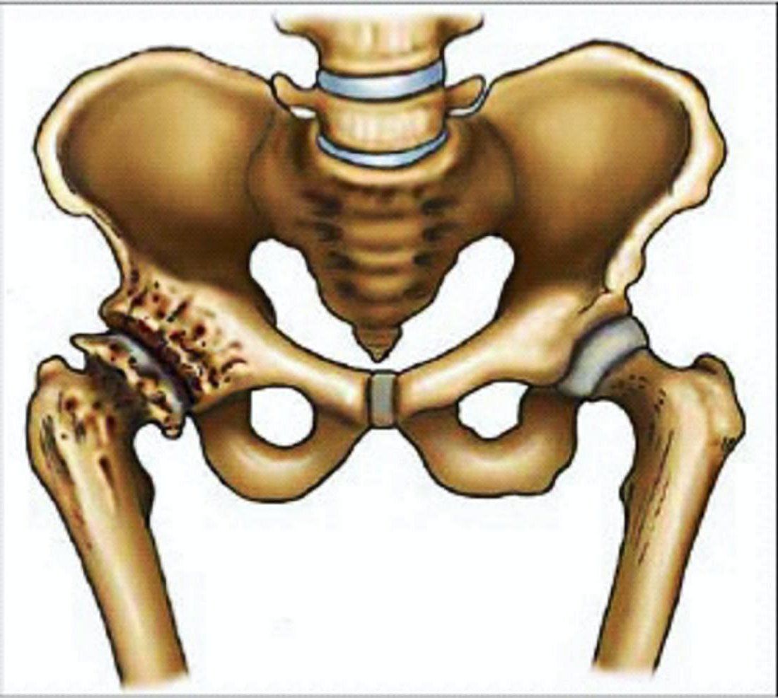 Степени остеоартроза тазобедренного сустава 46