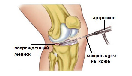 Строение мениска коленного сустава человека 54