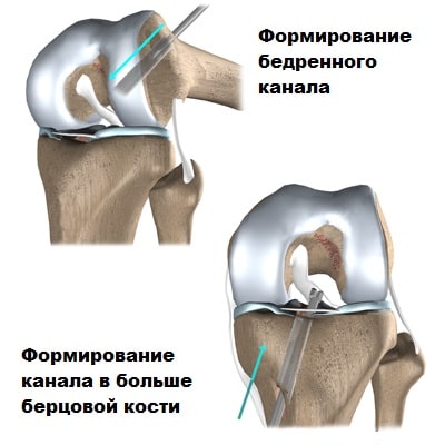 Травмы крестообразных связок коленного сустава 47