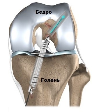 Травмы крестообразных связок коленного сустава 98