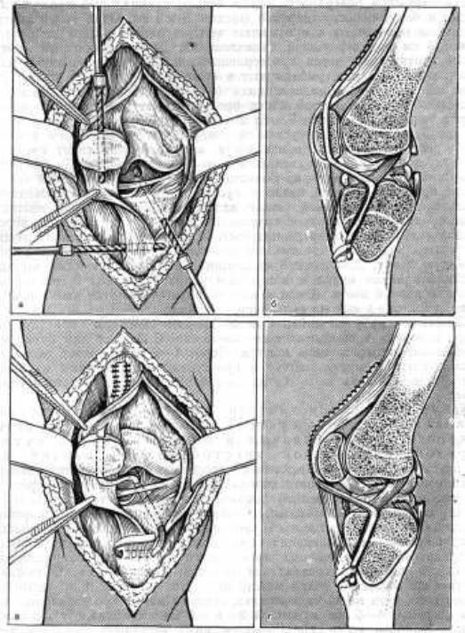Травмы крестообразных связок коленного сустава 66