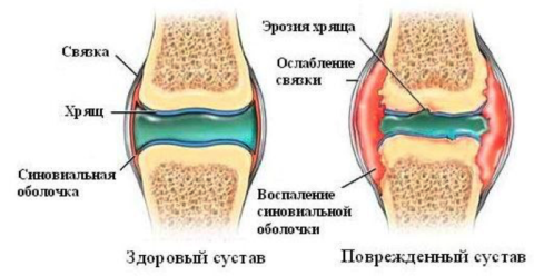 Уколы в коленный сустав препараты гиалуроновая кислота 22
