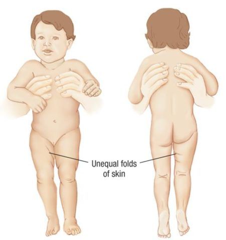 Ушиб таза или тазобедренного сустава у ребенка 47