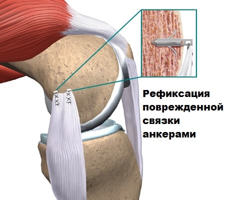 Внутреннее повреждение связок коленного сустава 53