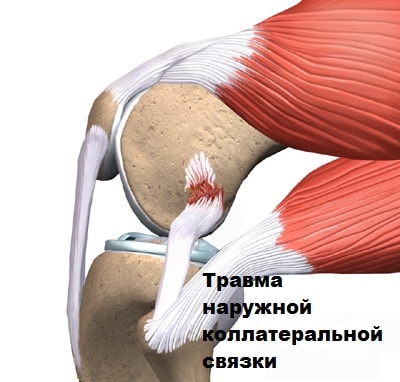 Внутреннее повреждение связок коленного сустава 59