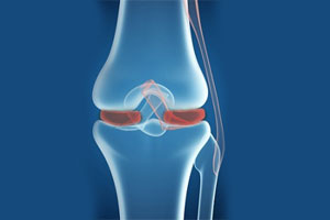 Воспаление коленного сустава чем лечить 169