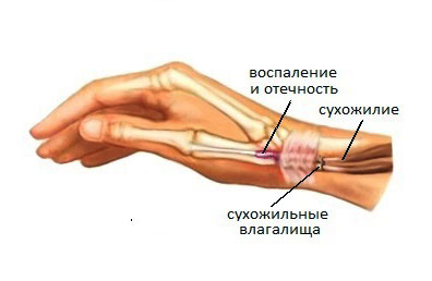 Воспаление лучезапястного сустава руки лечение 60