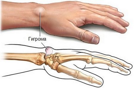 Воспаление лучезапястного сустава руки лечение 192