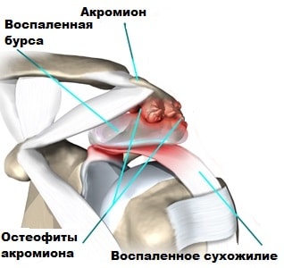 Воспаление сухожилия плечевого сустава 102