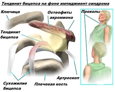 Воспаление сухожилия плечевого сустава 31