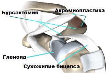 Воспаление сухожилия плечевого сустава 4