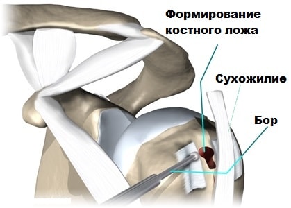 Воспаление сухожилия плечевого сустава 9