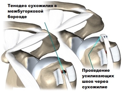 Воспаление сухожилия плечевого сустава 128